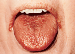 Tongue with Dry Mouth Xerostomia