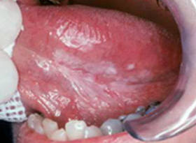 Oral Cancer - tongue