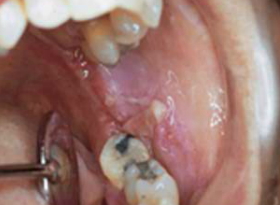 Oral Cancer - cheek