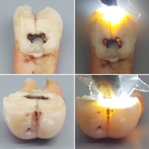 bruxism