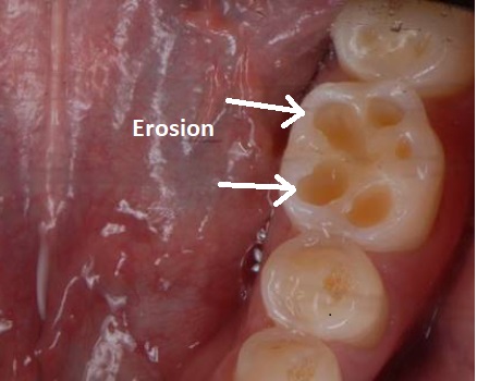 Gum Erosion