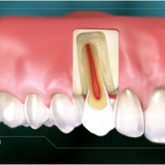 The Truth About Root Canals