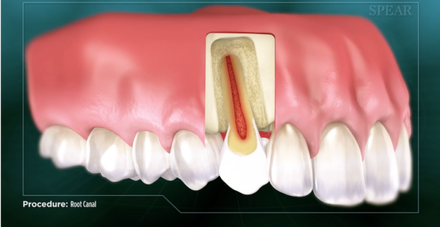 The Truth About Root Canals