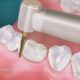 Educational Video: How Crowns are Treated