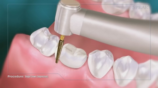 Educational Video: How Crowns are Treated | North Delta Dental