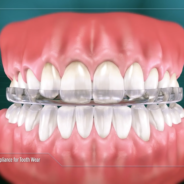 Occlusal Appliance for Tooth Wear
