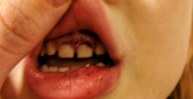 Dental Trauma 2.0 – Kid’s Teeth