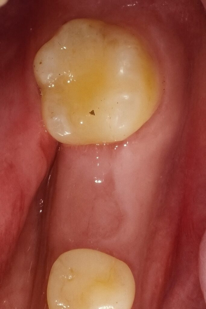 Case 1: Before dental implant
