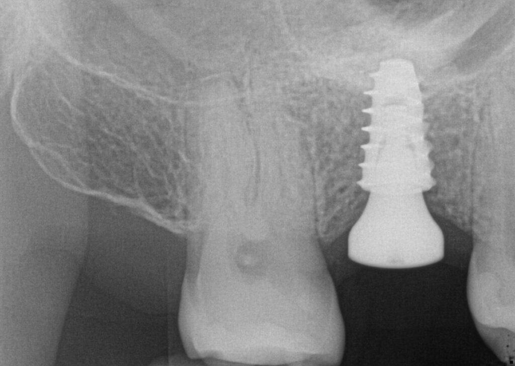 Case 2: X-ray immediately after implant placement