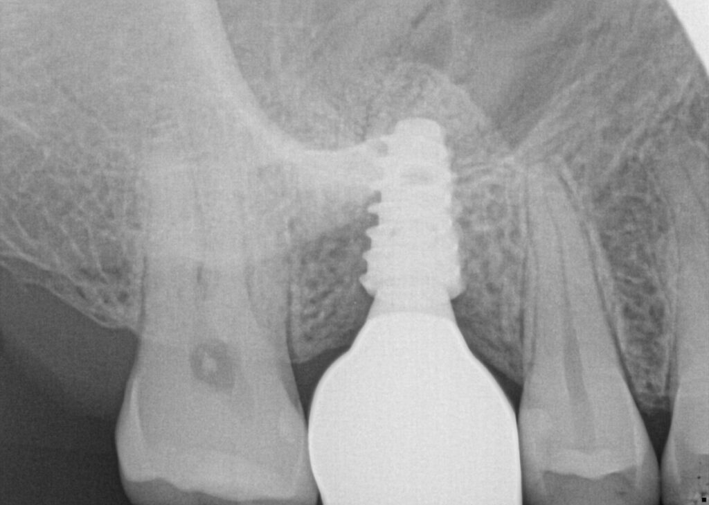 Case 2: X-ray of implant restored with crown