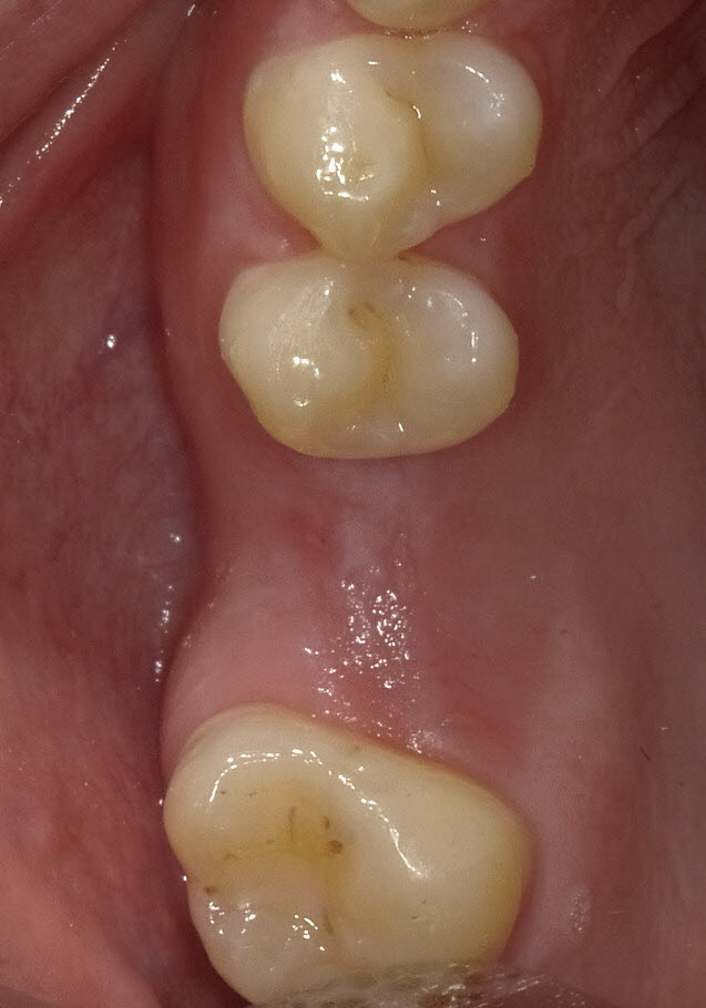 Case 2: Before dental implant