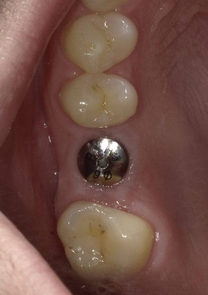 Case 2: Dental implant (after 2 months of healing)