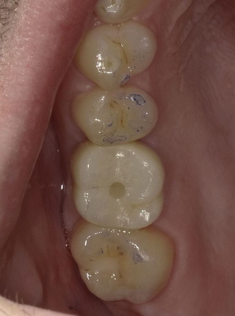 Case 2: Implant restored with crown (after 4 months of healing)