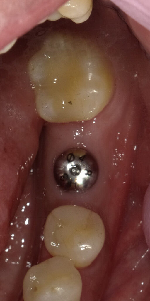 Case 1: Dental implant (after 2 months of healing)