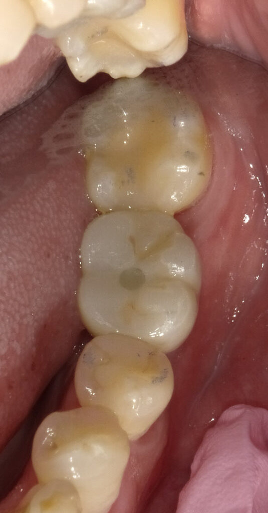 Case 1: Implant restored with crown (after 4 months of healing)