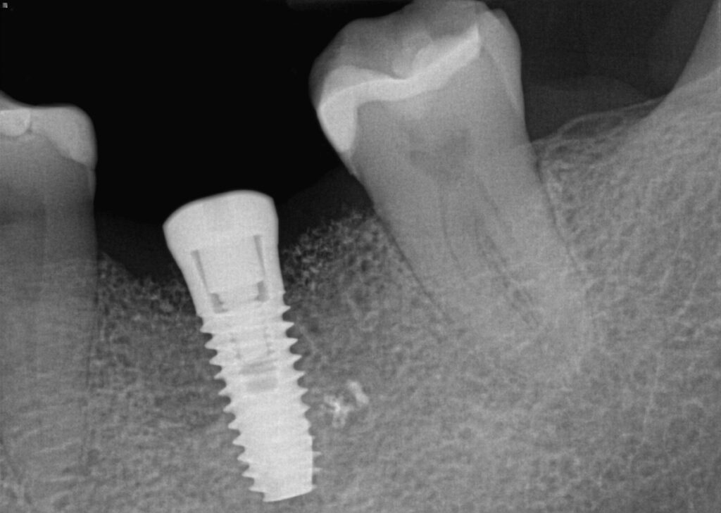 Case 1: X-ray immediately after implant placement