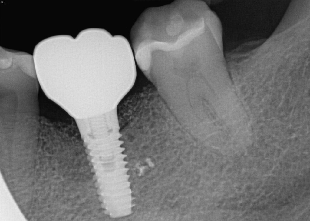 Case 1: X-ray of implant restored with crown