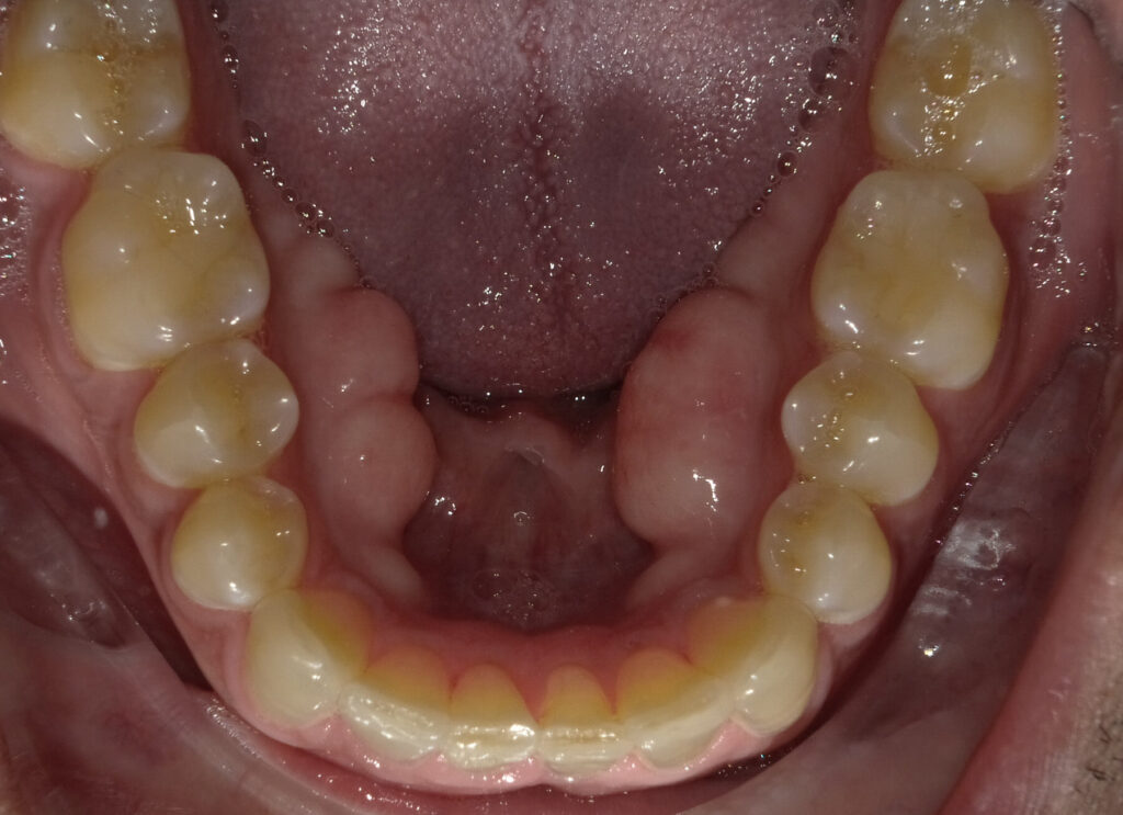 Case A After (Lower) Case A After (Lower)