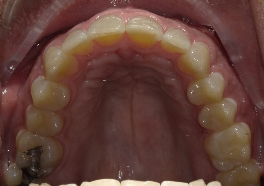 Case A After (Upper) Case A After (Upper)