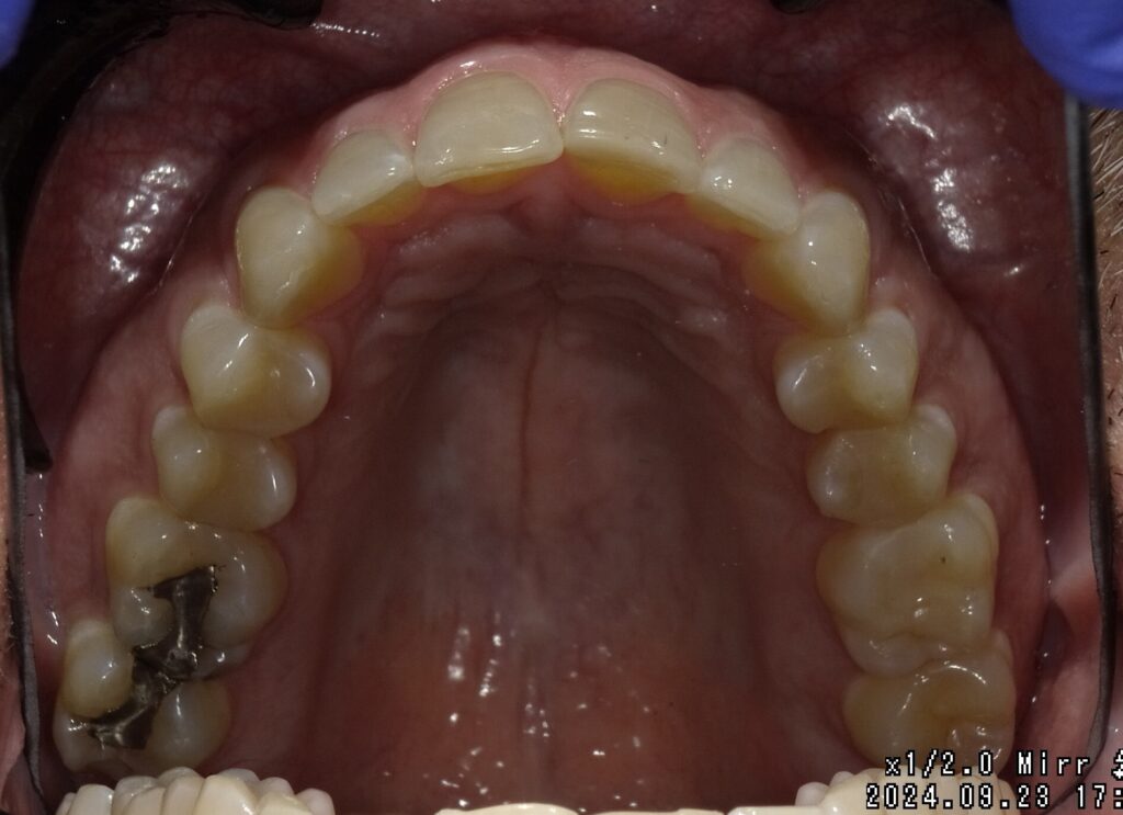 Case A Before (Upper) Case A Before (Upper)