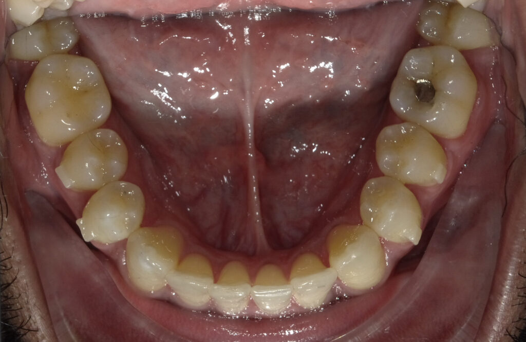 Case B After (Lower) Case B After (Lower)