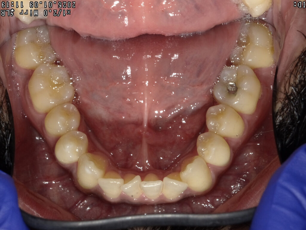 Case B Before (Lower) Case B Before (Lower)