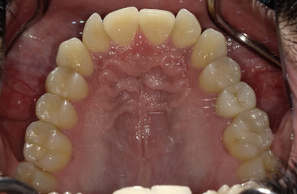 Case B Before (Upper) Case B Before (Upper)